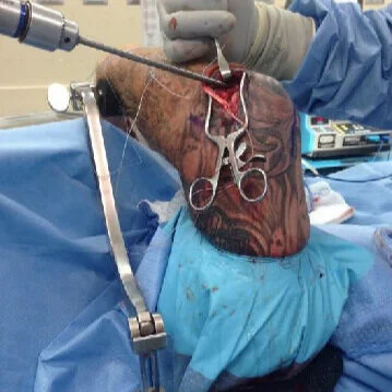 Lateral Ulna Collateral Ligament Reconstruction