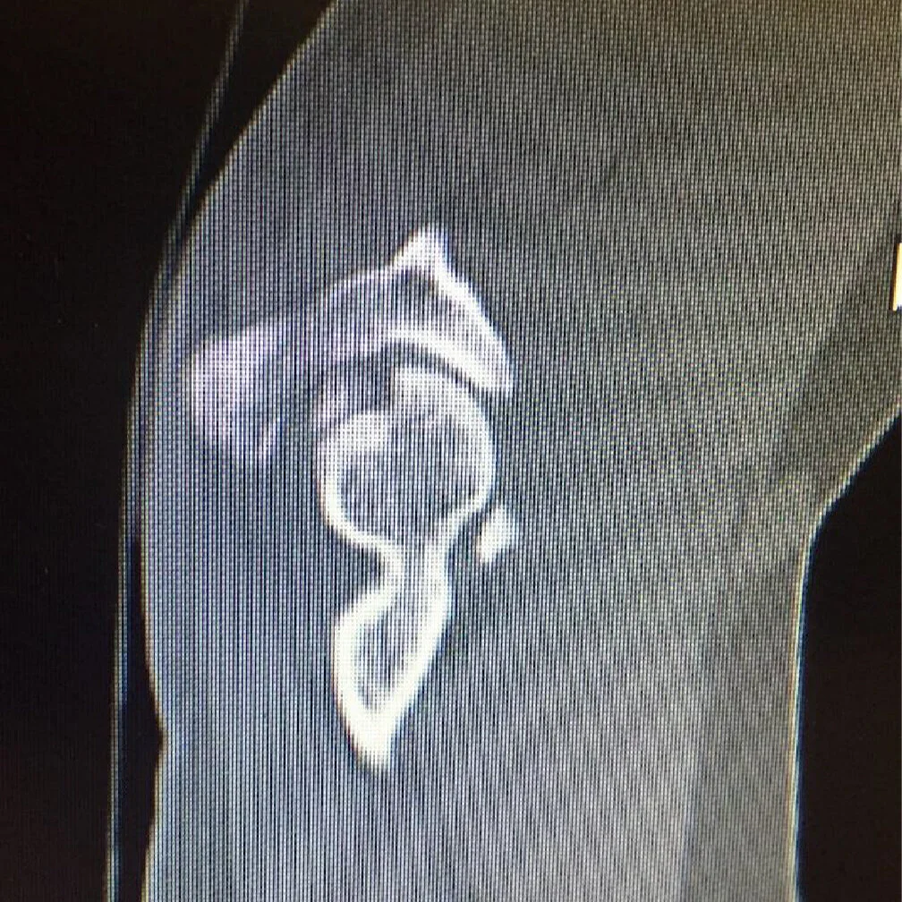 Supine Elbow Arthroscopy for Post Traumatic Loose Bodies