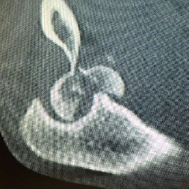 Terrible Triad Elbow Injury with Coronal Shear Trochlea Fracture