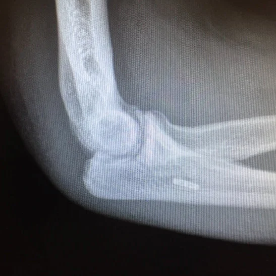 Elbow UCL Reconstruction with Olecranon Nonunion