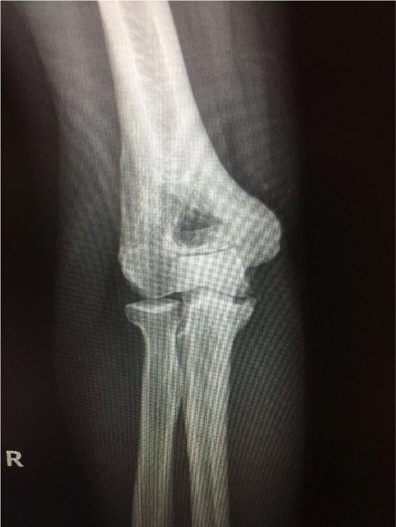 Elbow UCL Reconstruction with Olecranon Nonunion(Image2).jpg