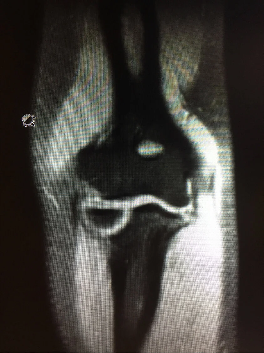 Elbow UCL Reconstruction with Olecranon Nonunion(Image3).jpg