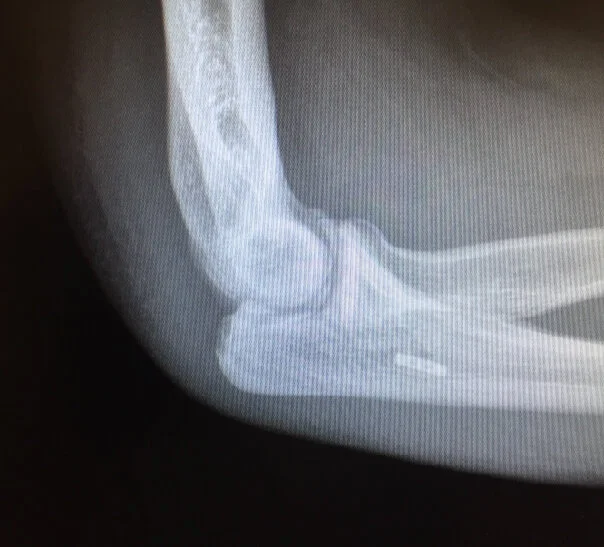 Elbow UCL Reconstruction with Olecranon Nonunion(Image6).jpg