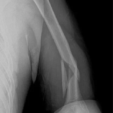 Distal Humeral Shaft Fracture