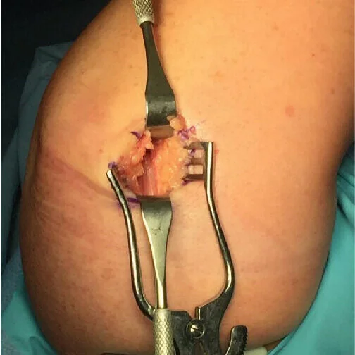 Obese Patient Ulnar Nerve Decompression