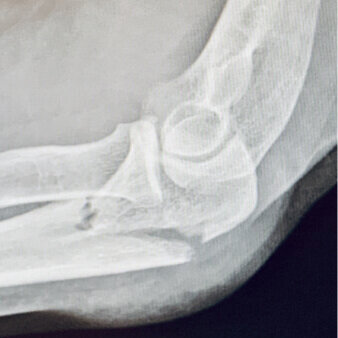 Proximal Ulna Fractures Simplified