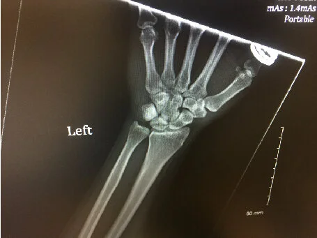 Triad Variant with Radial Head Extrusion(Image3).jpg