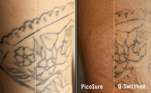 (Left) Shows the tattoo before treatment.&nbsp;(Right) Shows the tattoo after just one treatment using our laser technology vs. the old technology.