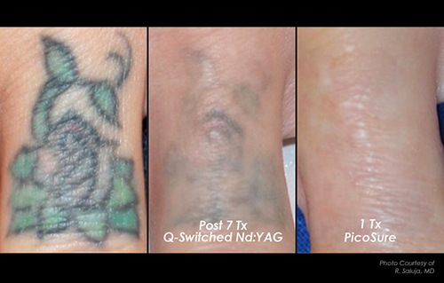 Before & After — Invisible Ink Tattoo Removers in Pittsburgh, Minneapolis  and Richmond. New Picosure Laser tattoo removal.