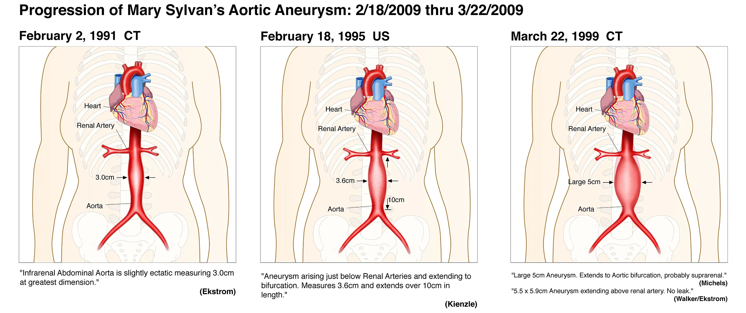 Heart Aneurism2.jpg