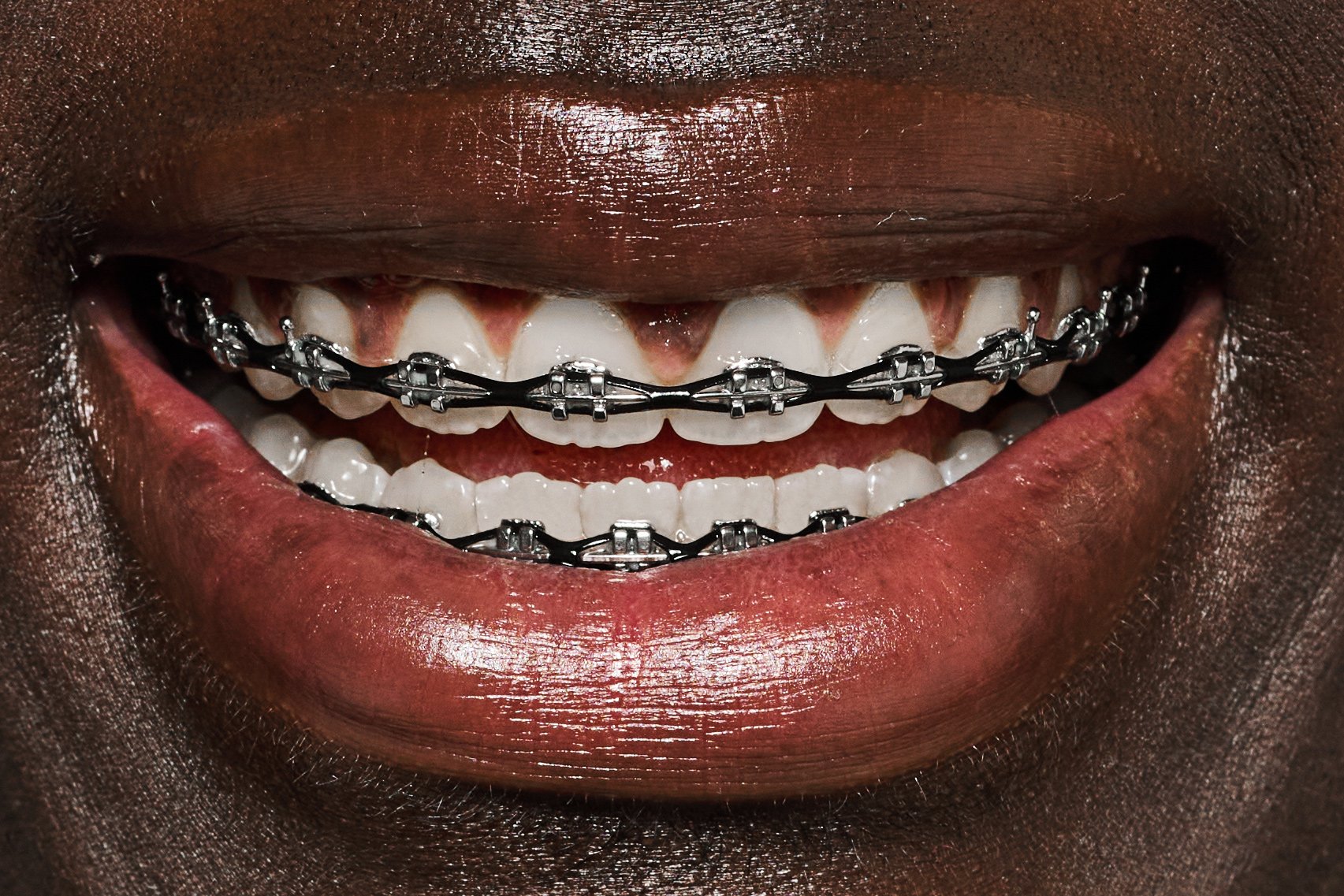 Brace Face - Nik Williams - Shot by Nik Williams in California 
