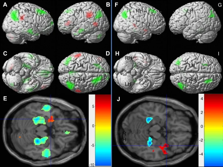 Fig. 1. Main Effects of Emotion. Regions showing significant BOLD response differences for emotion-laden versus neutral passages ( Table 3 ) – created using xjView toolbox. Red color indicates significant positive differences (Emotion > Neutral). Green and blue indicate significant negative differences (Emotion < Neutral). A and F: right lateral view; B and G: left lateral view; C and H: inferior view; D and I: superior view; Left Panel: Fear versus Neutral; E: transverse section highlighting left amygdala.; Right Panel: Happy versus Neutral; J: transverse section highlighting right anterior temporal cortex.