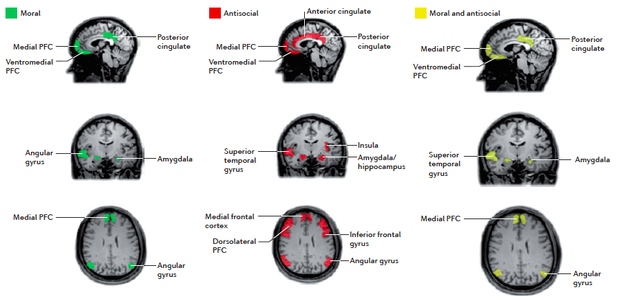 A schematic diagram of brain regions that are activated only in moral decision making (green), regions that are impaired only in antisocial groups (red), and regions common to both antisocial behaviour and moral decision making (yellow). This overlap gives rise to the ‘neuromoral’ hypothesis of antisocial behaviour, which states that some of the brain impairments that are observed in antisocial individuals disrupt moral emotion and/or decision making, thereby predisposing individuals to rule-breaking, antisocial behaviour. 