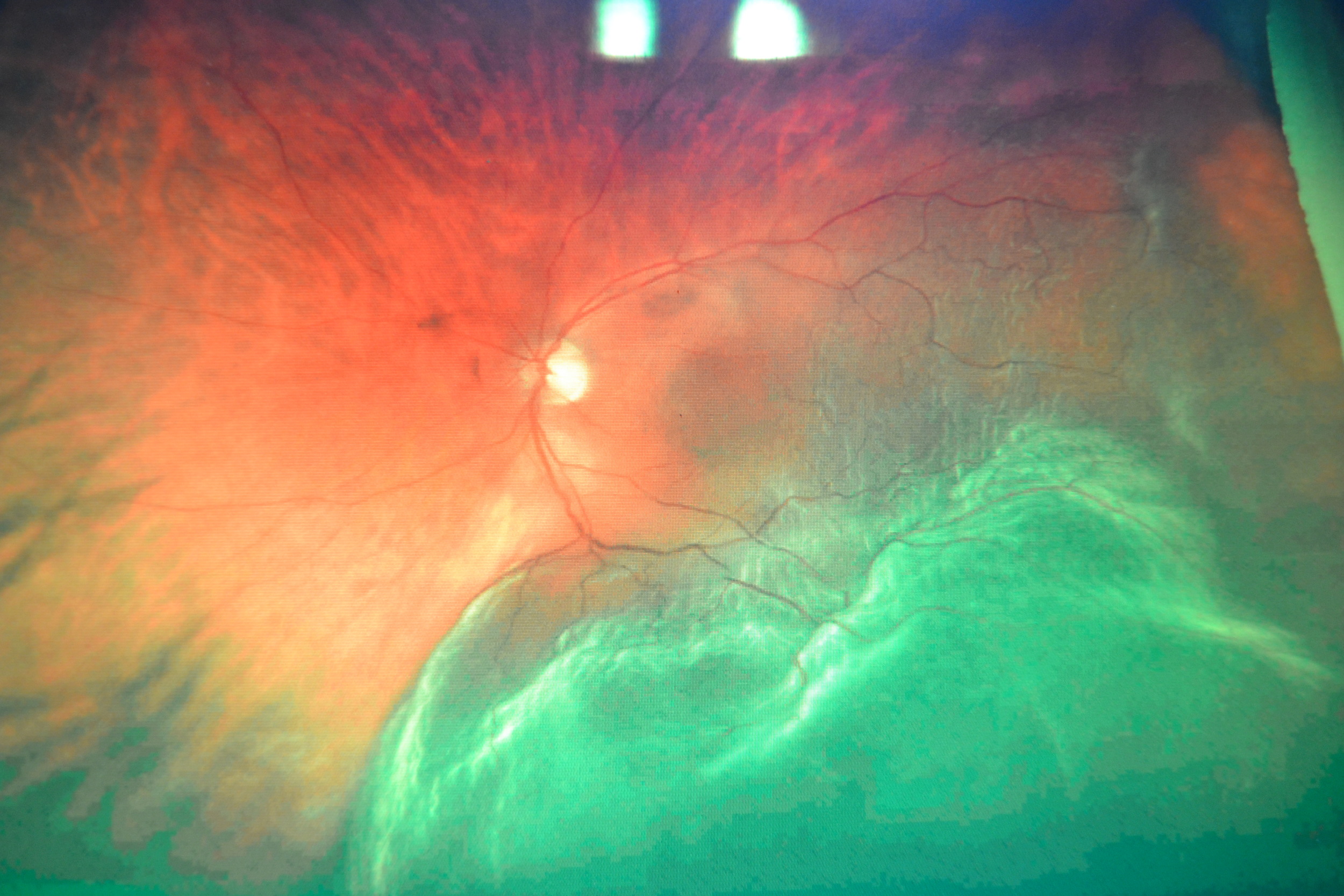 Retinal Detachment on Optos Imager