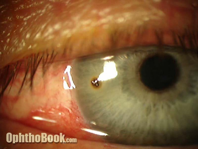Image of Corneal Foreign Body from ophthobook.com