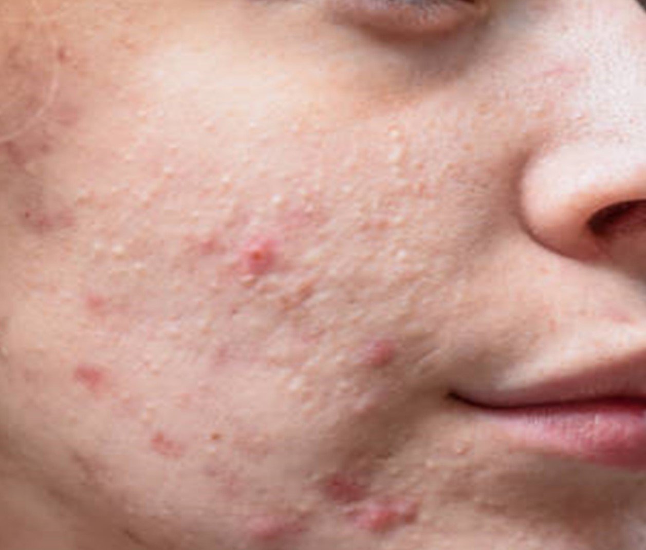 milia + pimples