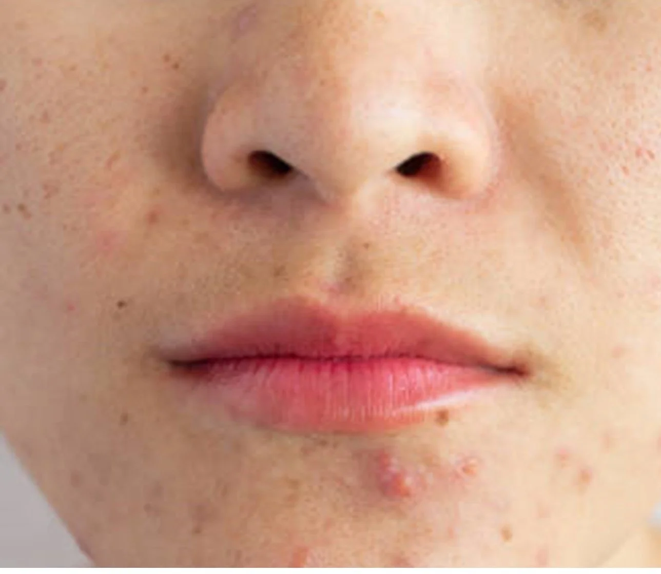 occasional small pimples