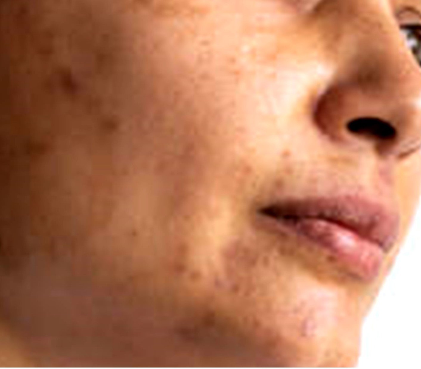 hyperpigmentation