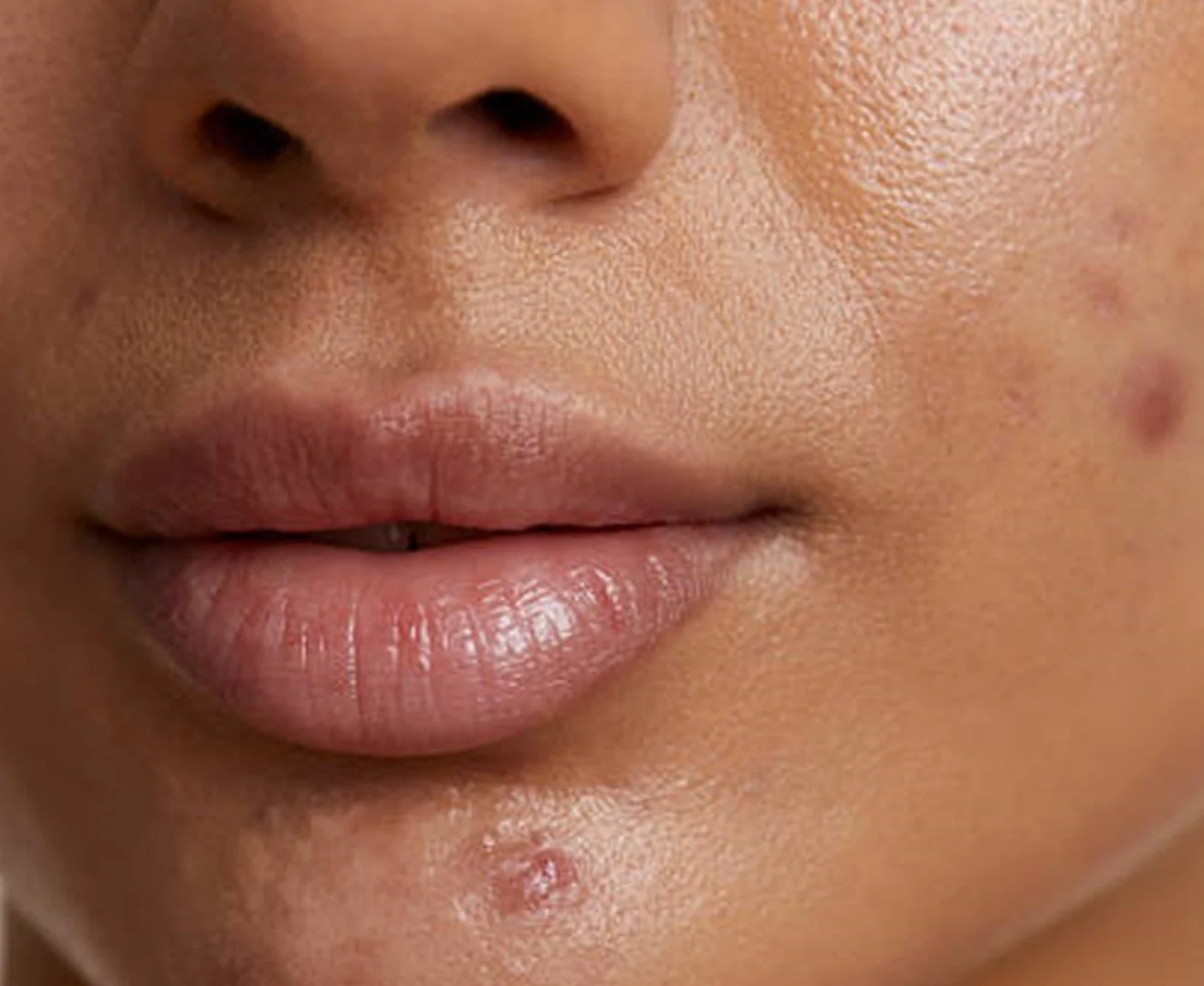 dark marks/breakouts