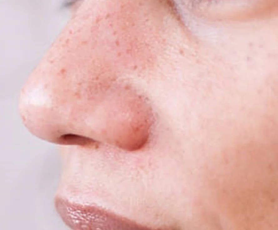 small blackheads