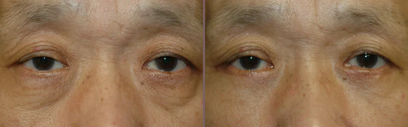 Lower Blepharoplasty_00000.jpg