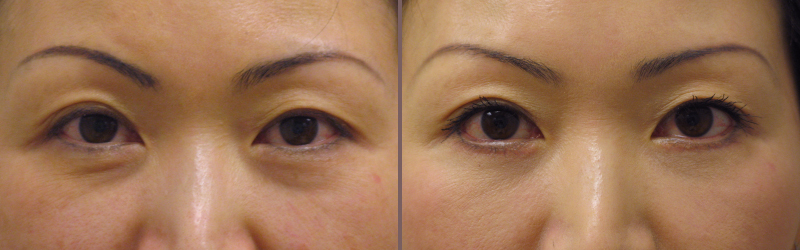 Lower Blepharoplasty_00004.jpg