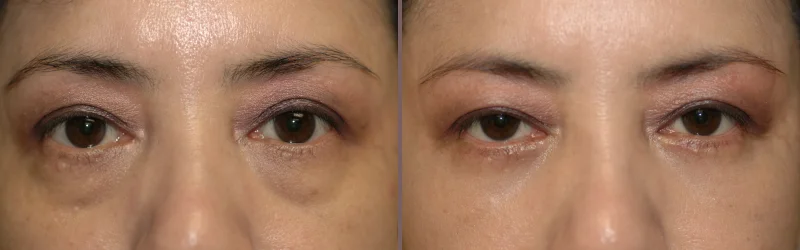 Lower Blepharoplasty_00003.jpg