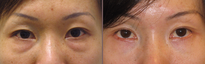 Lower Blepharoplasty_00005.jpg