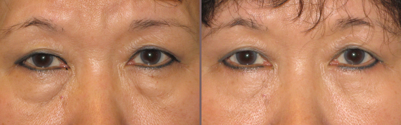 Lower Blepharoplasty_00006.jpg