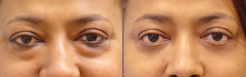 Lower Blepharoplasty_00008.jpg