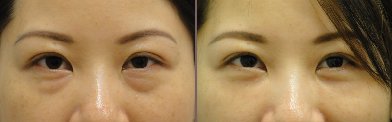 Lower Blepharoplasty_00009.jpg