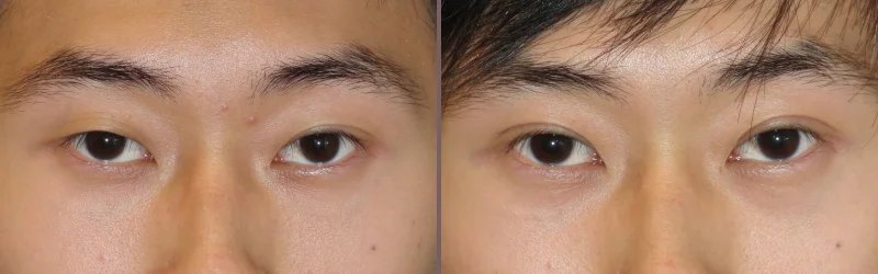 Asian Blepharoplasty_00000.jpg