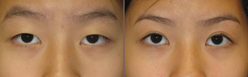 Asian Blepharoplasty_00004.jpg
