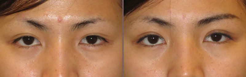 Asian Blepharoplasty_00003.jpg