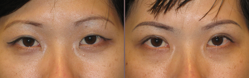 Asian Blepharoplasty_00005.jpg