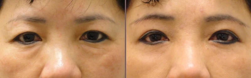 Upper Lower Blepharoplasty_00001.jpg