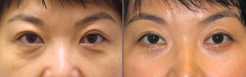 Upper Lower Blepharoplasty_00004.jpg