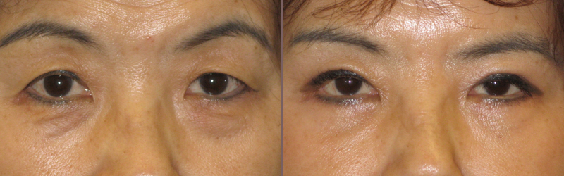 Upper Lower Blepharoplasty_00006.jpg