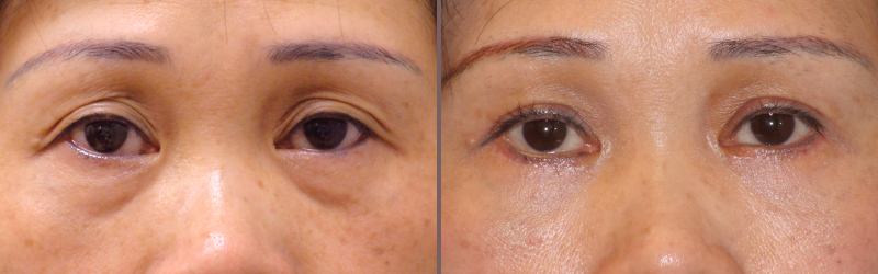 Upper Lower Blepharoplasty_00007.jpg