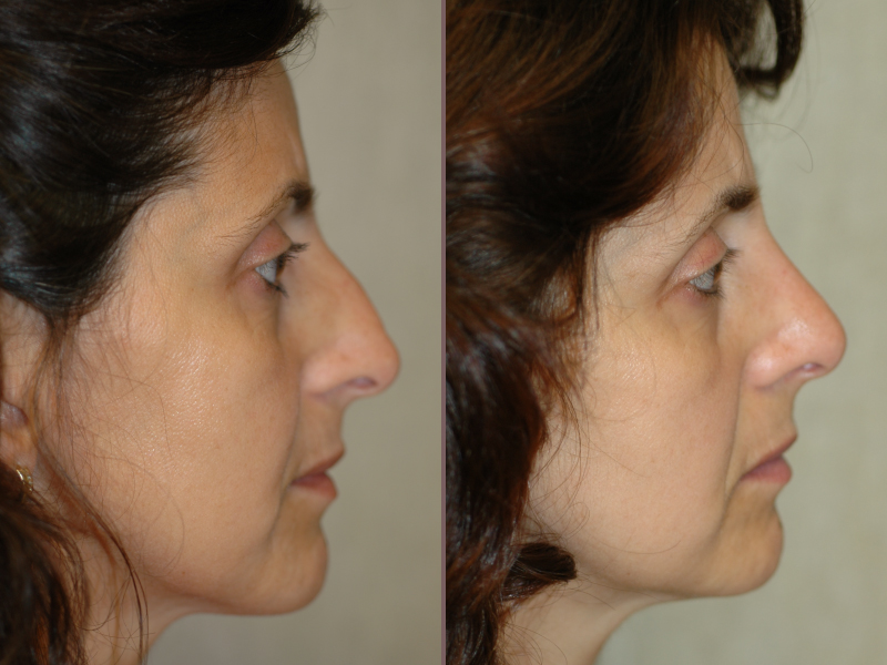 Nose Rhinoplasty_00000.jpg