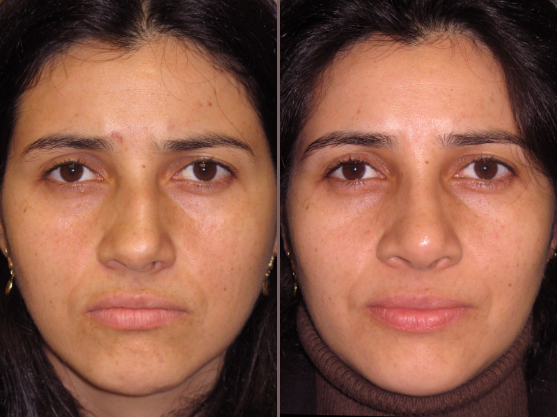 Nose Rhinoplasty_00003.jpg