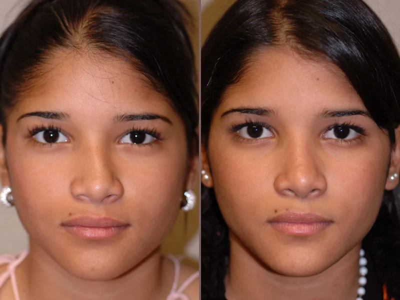 Nose Rhinoplasty_00005.jpg