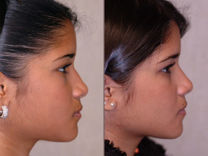 Nose Rhinoplasty_00006.jpg