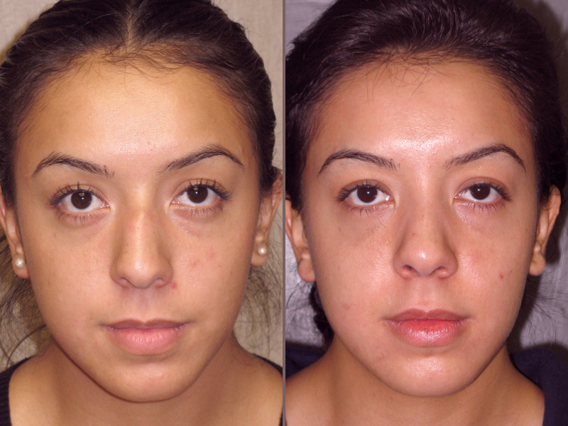 Nose Rhinoplasty_00007.jpg