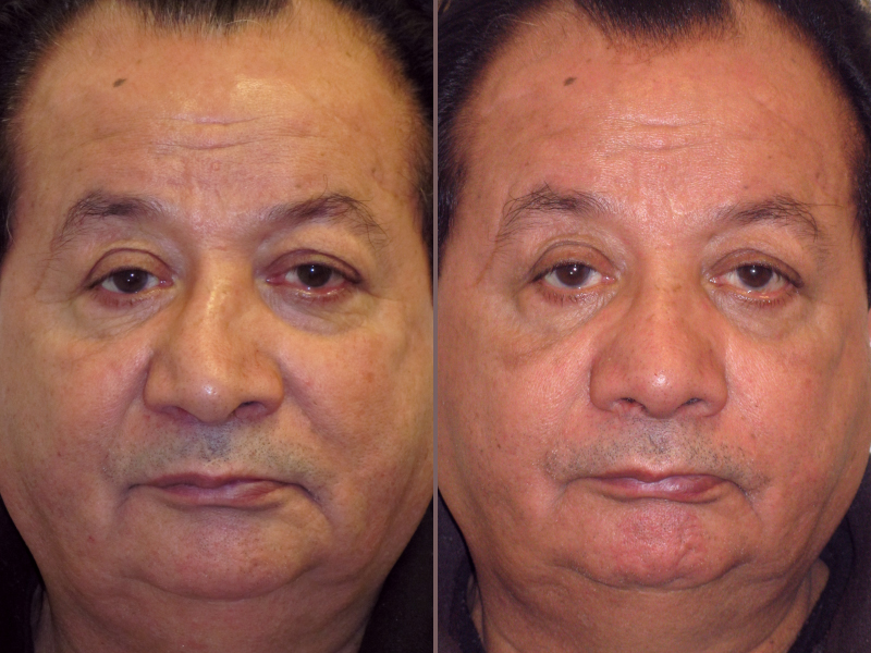 Nose Rhinoplasty_00009.jpg