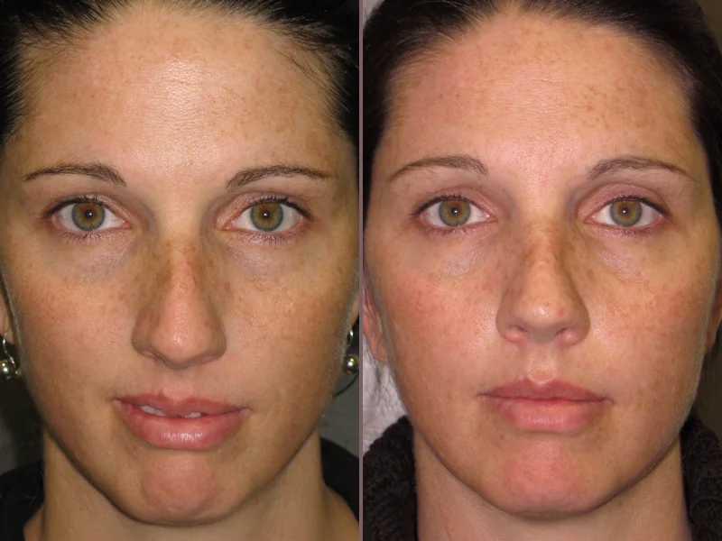 Nose Rhinoplasty_00010.jpg