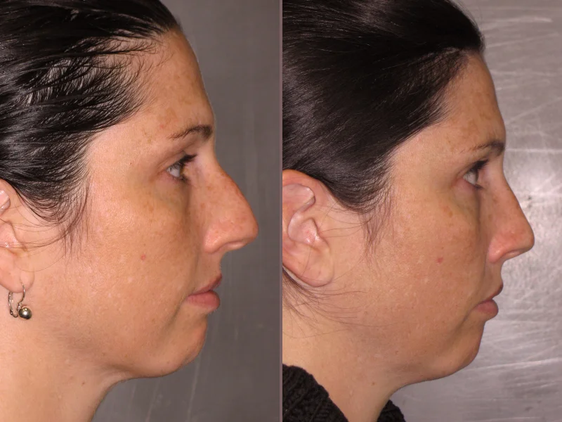 Nose Rhinoplasty_00011.jpg