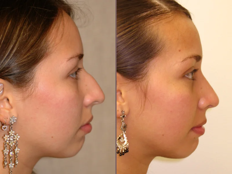 Nose Rhinoplasty_00013.jpg