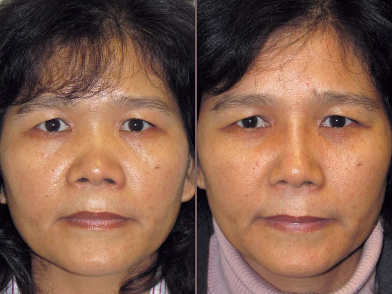 Nose Rhinoplasty_00016.jpg