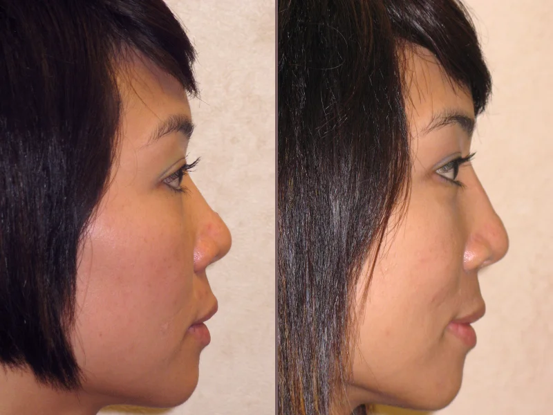 Nose Rhinoplasty_00018.jpg